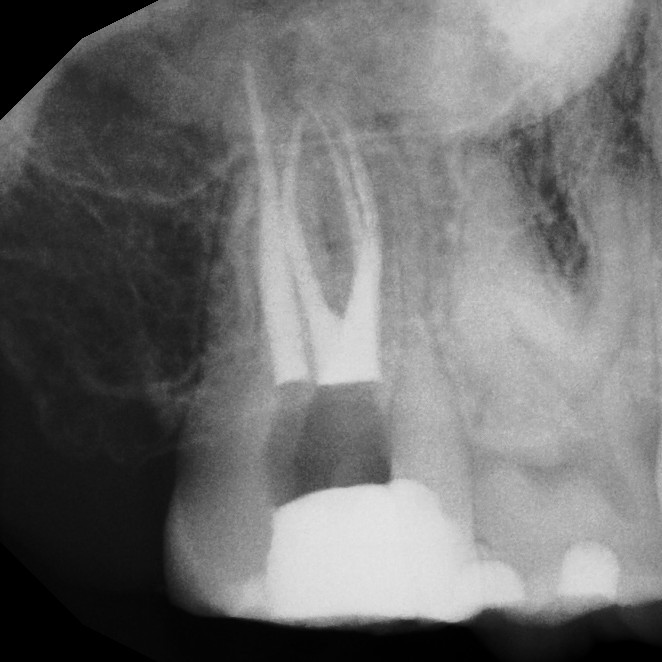 After Endodontic Treatment Case 1 - Harp Endodontics Manhattan New York